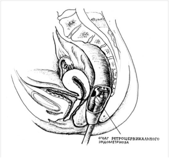 рисунок  Эндометриоз кишки мочевого пузыря лечение операция лапароскопия трансанальное введение циркулярного степлера эндометриодный очаг