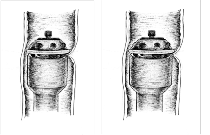 Рисунок Эндометриоз кишки мочевого пузыря лечение операция лапароскопия сегментарная резекция толстой кишки с циркулярным степлером