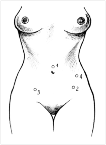 Рисунок Удаление матки рак аденомиоз операция лапароскопия ампутация экстирпация матки точки введения троакаров