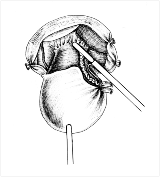 Рисунок Удаление матки миома аденомиоз операция лапароскопия ампутация экстирпация матки 