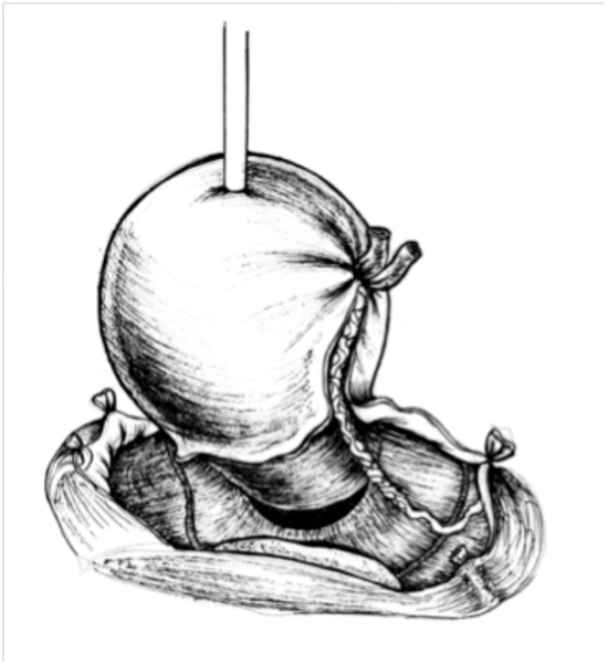 Рисунок Удаление матки миома аденомиоз операция лапароскопия вскрытие заднего свода влагалища